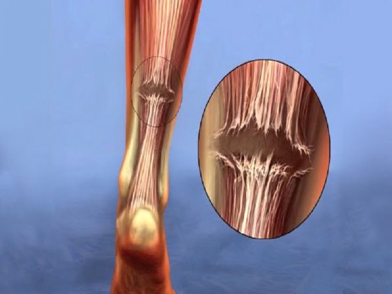 achilles tendon rupture feature compressor - پارگی زردپی آشیل به چه دلیل اتفاق می افتد؟