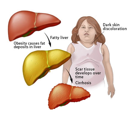 graphic fatty liver کبد چرب - کبد چرب چیست درمان طبیعی و گیاهی آن را بدانید