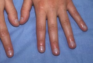 nails and health salemzi 5 300x204 - تغییر رنگ و شکل ناخن، نشانه ای از بیماری!