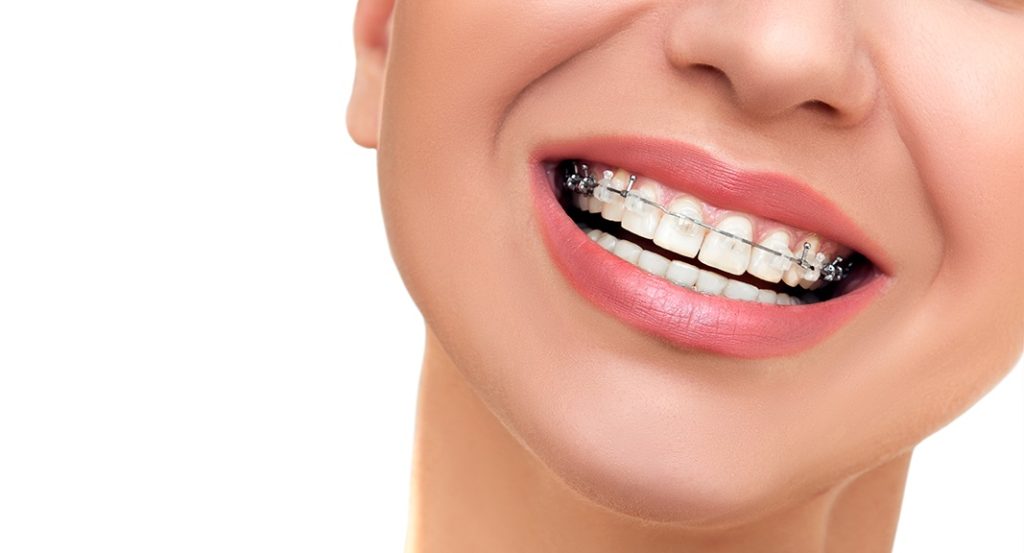 ssiimm ortodoncia 1024x553 - بهداشت دندان ارتودنسی