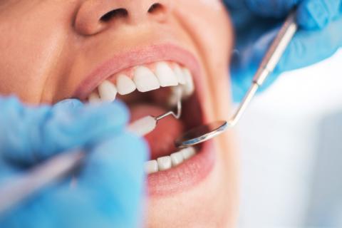 ssiimm mds tandarts1 - چه مواقعی دندان باید عصب کشی شود؟