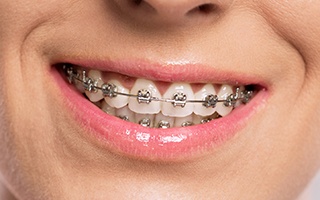 ssiimm orthodontics 1 - سن مناسب ارتودنسی